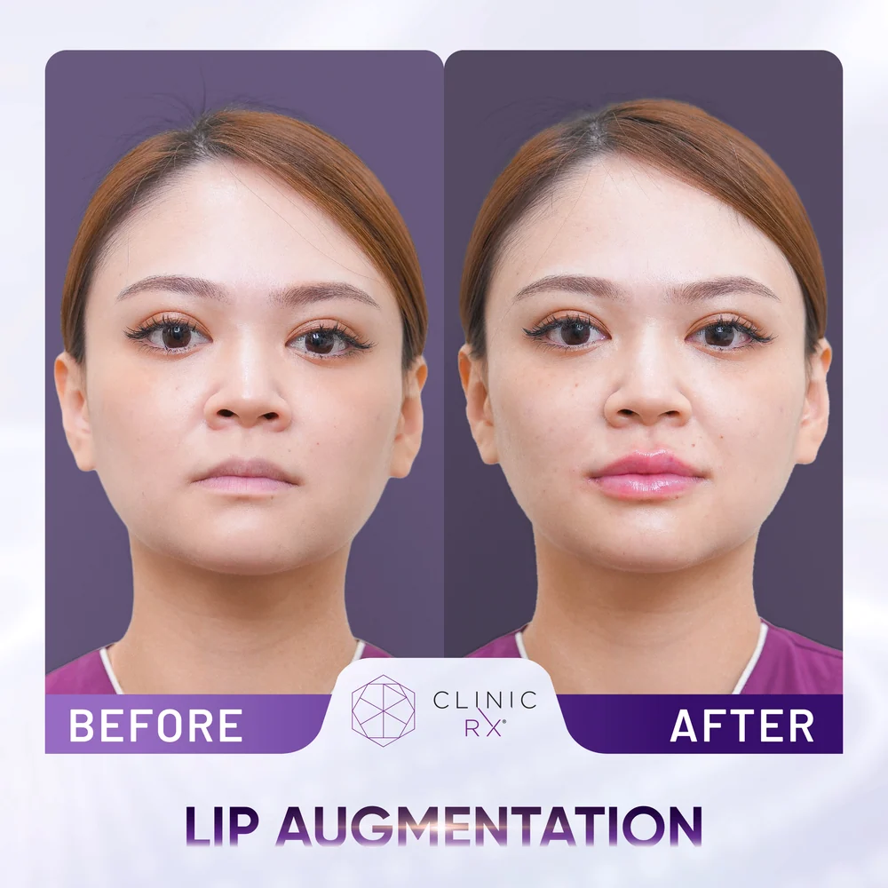Thin Lips result 3