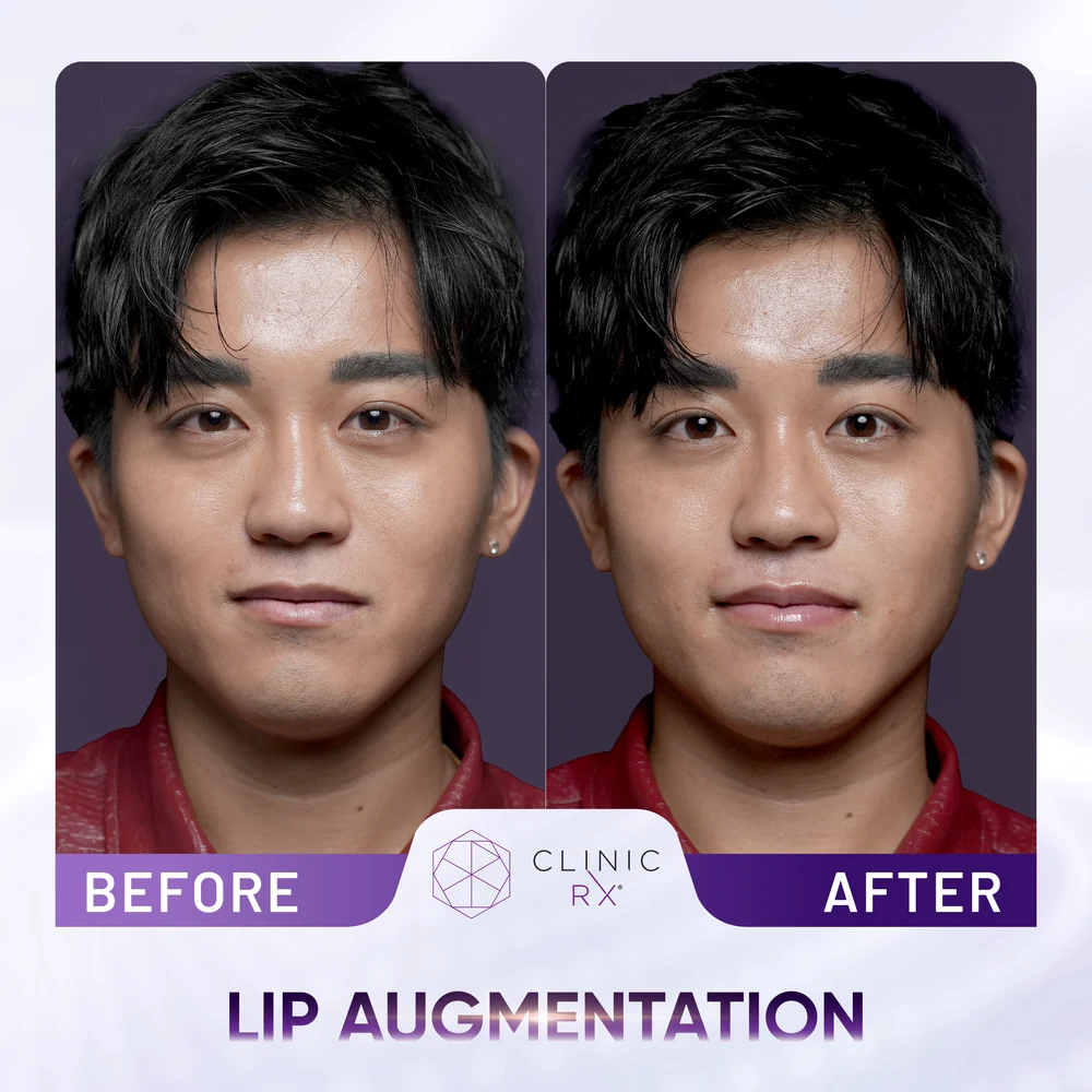 Thin Lips result 4