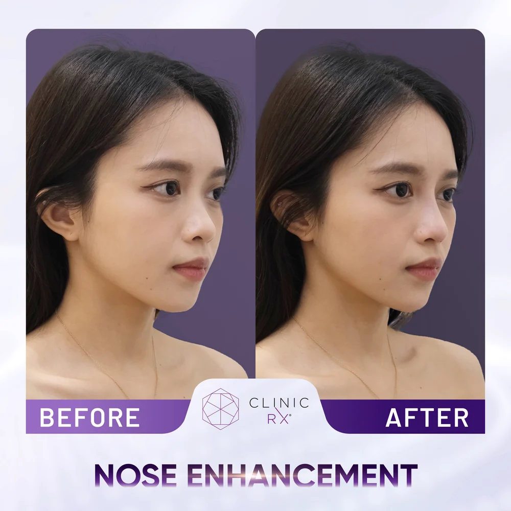 Undefined Nose result 1