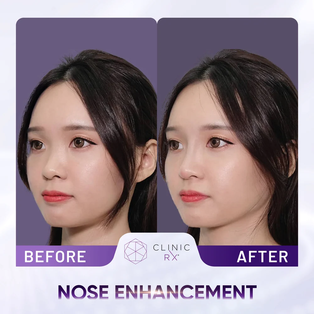Undefined Nose result 2