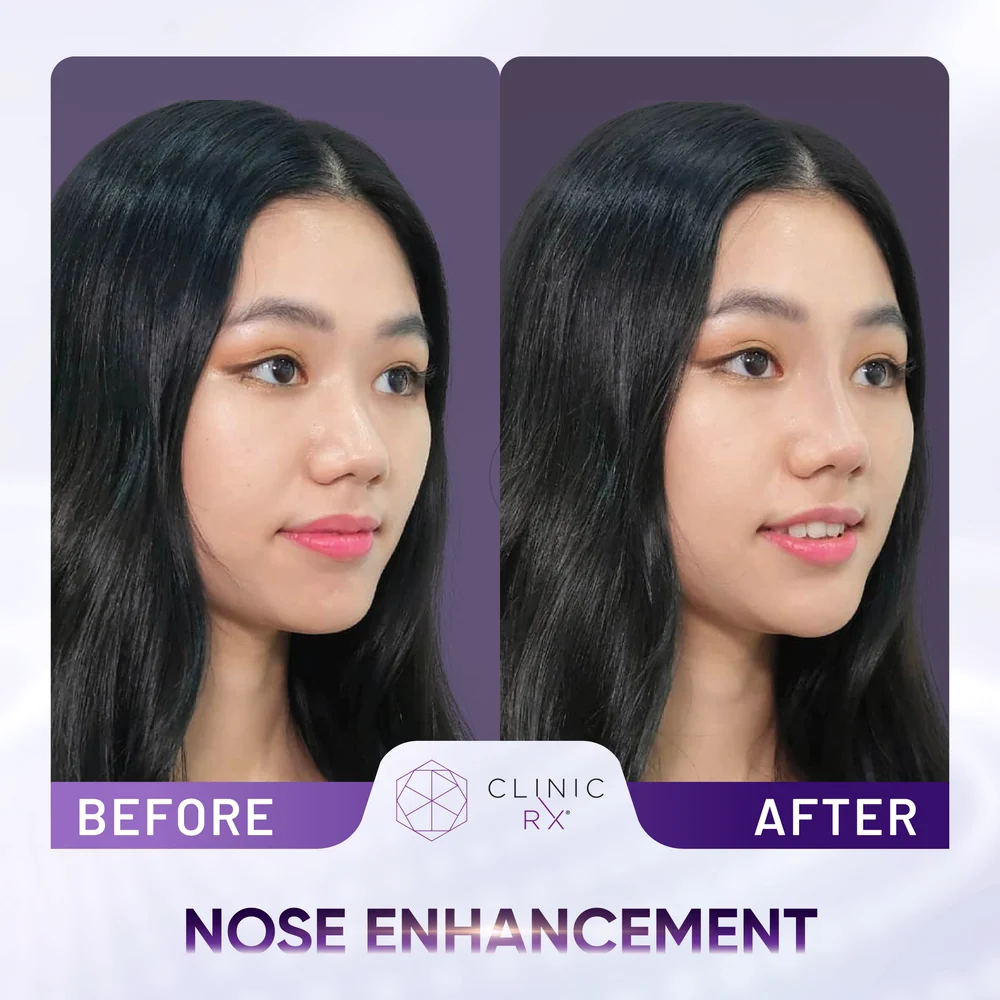 Undefined Nose result 3