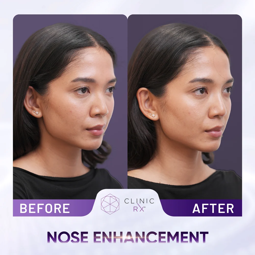 Undefined Nose result 4