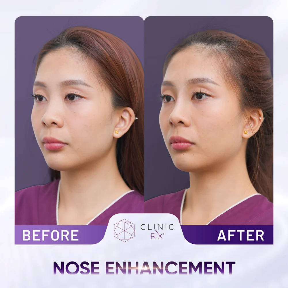 Undefined Nose result 5