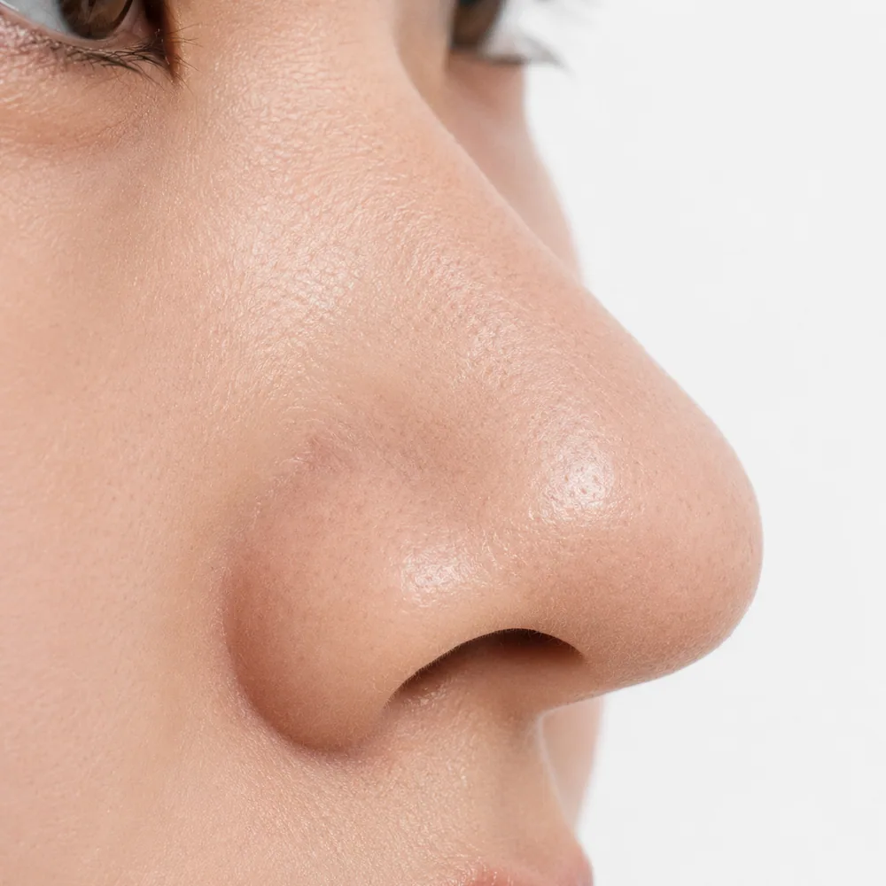 Disproportionate Nose