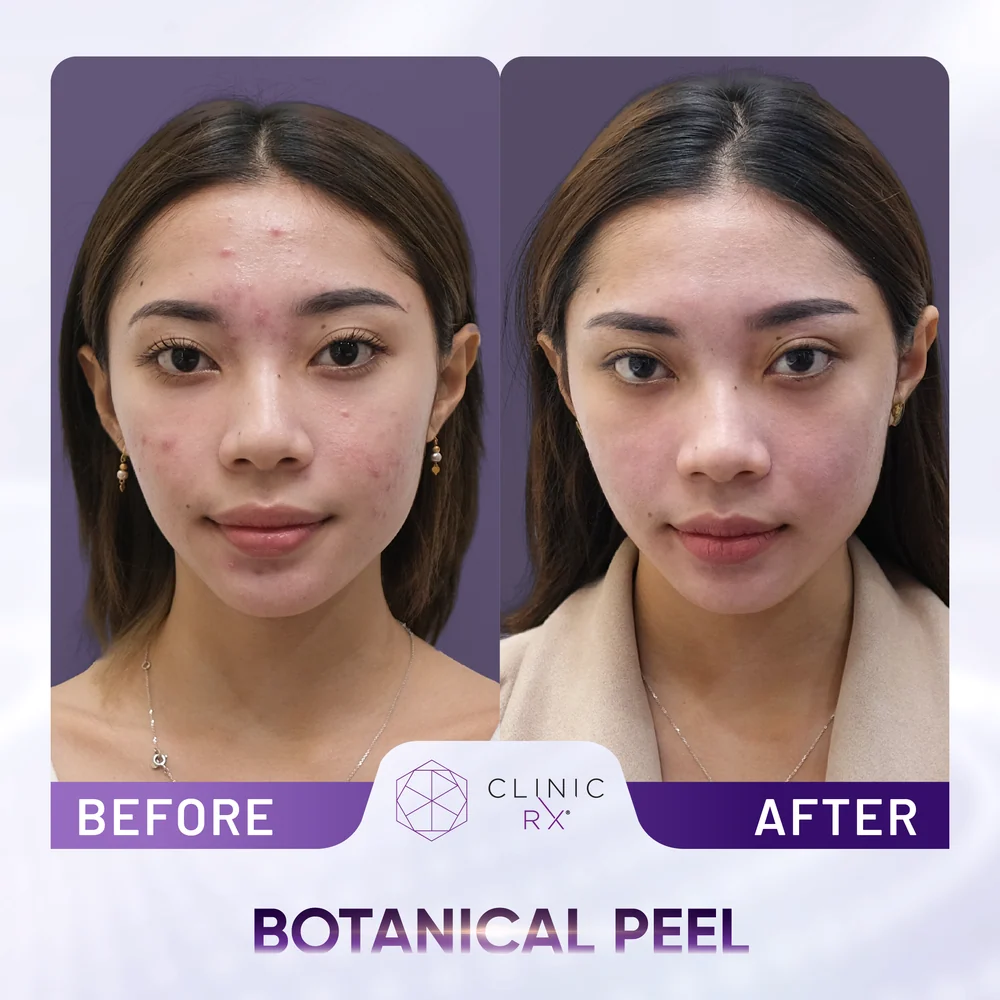 Uneven Skin Texture result 1