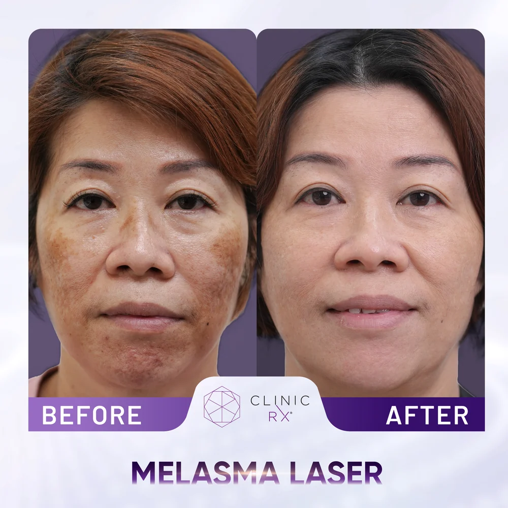 Uneven Skin Texture result 7