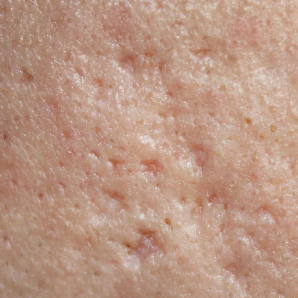 Rough, Dry Texture