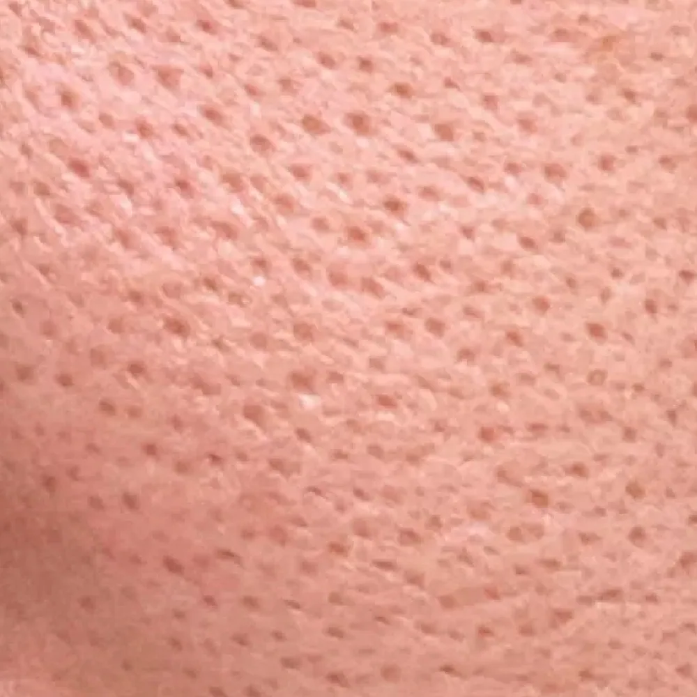Enlarged Pores