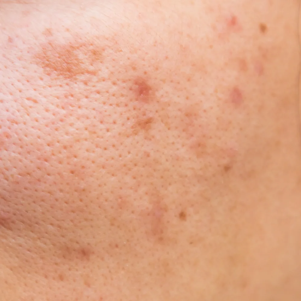 Uneven Surface