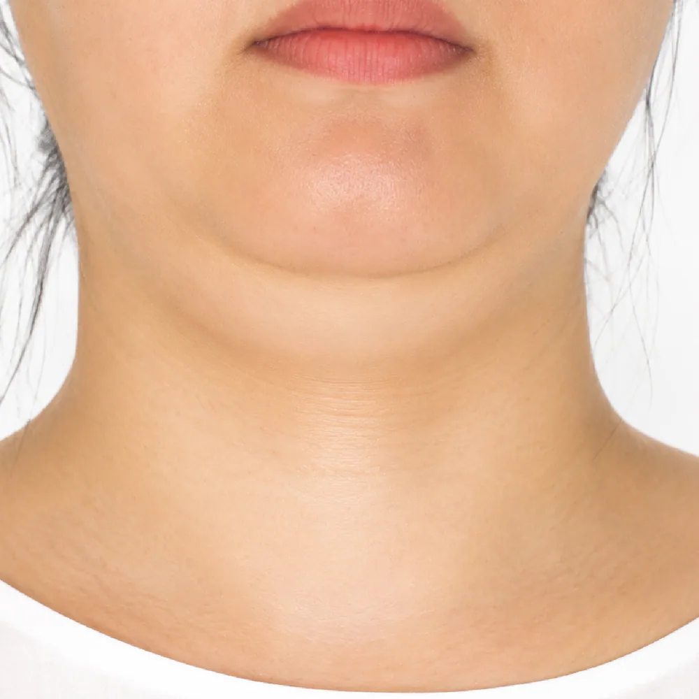 Double Chin