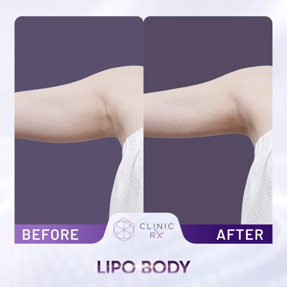 Unwanted Fat result 1