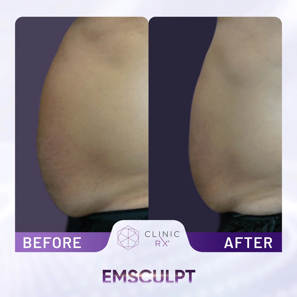 Unwanted Fat result 3