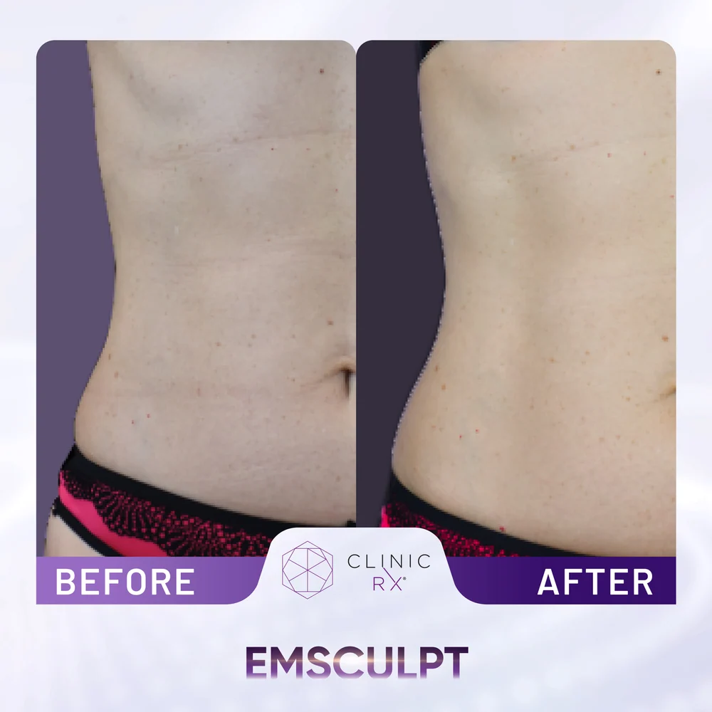 Unwanted Fat result 4