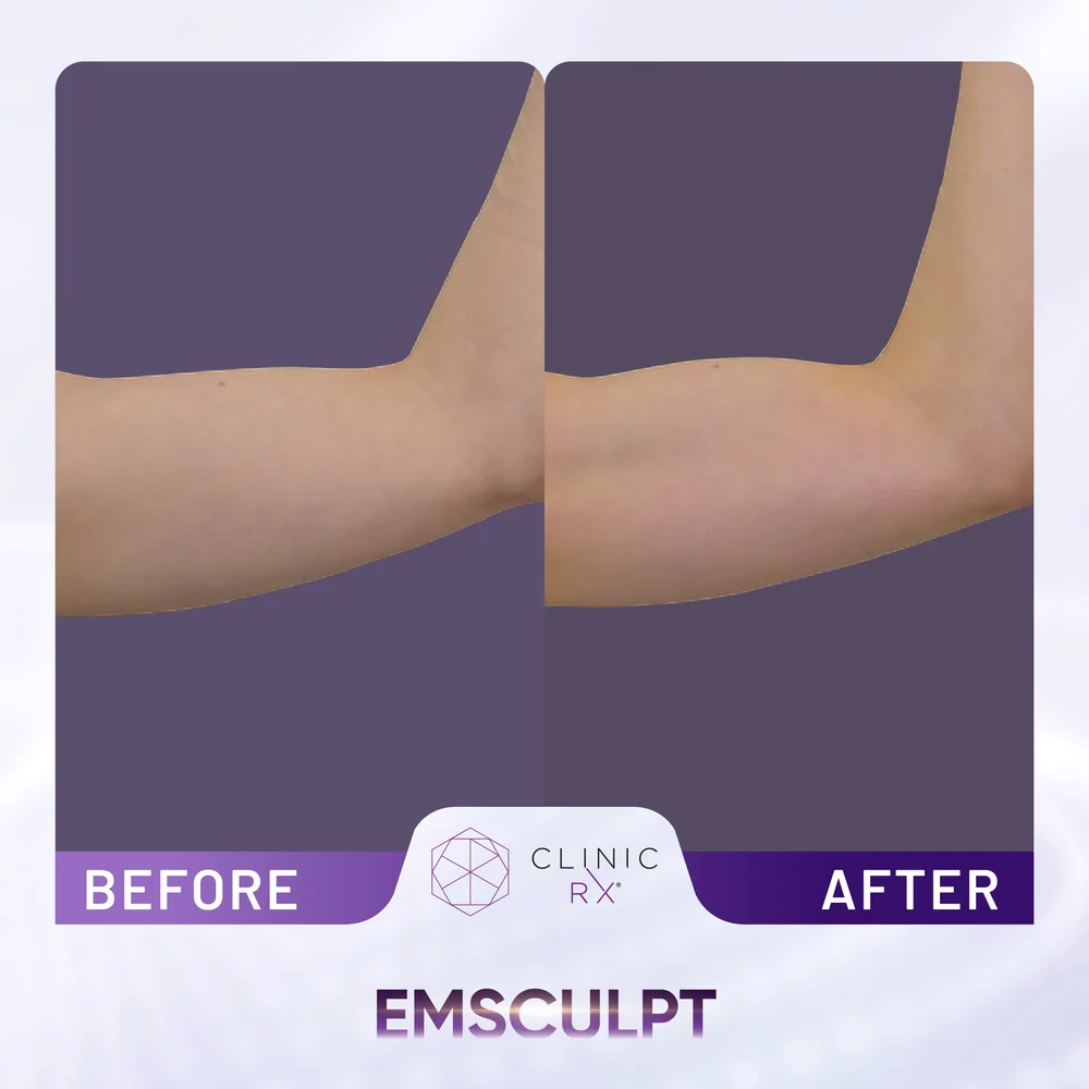 Unwanted Fat result 5