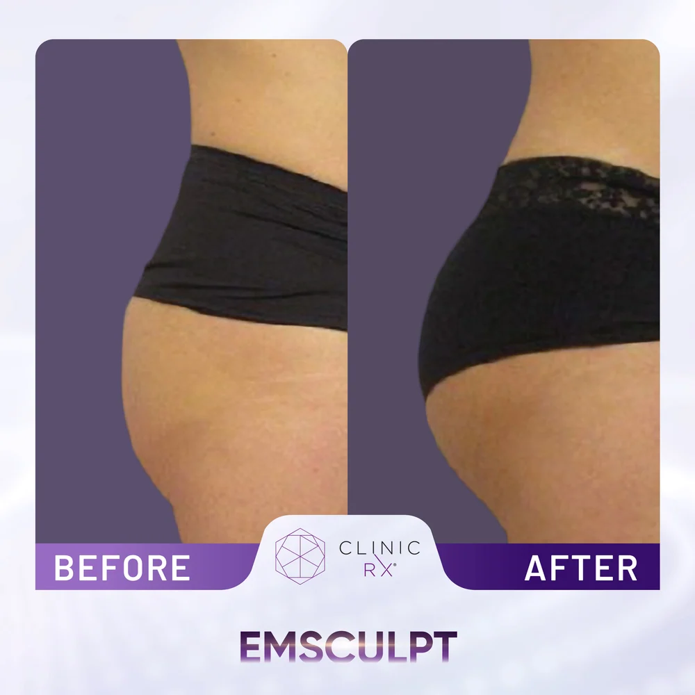 Unwanted Fat result 6