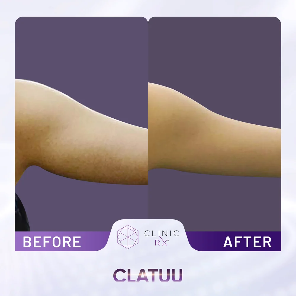 Unwanted Fat result 8