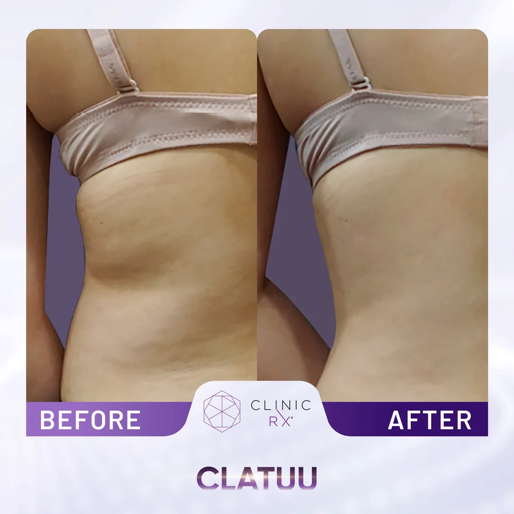 Unwanted Fat result 9