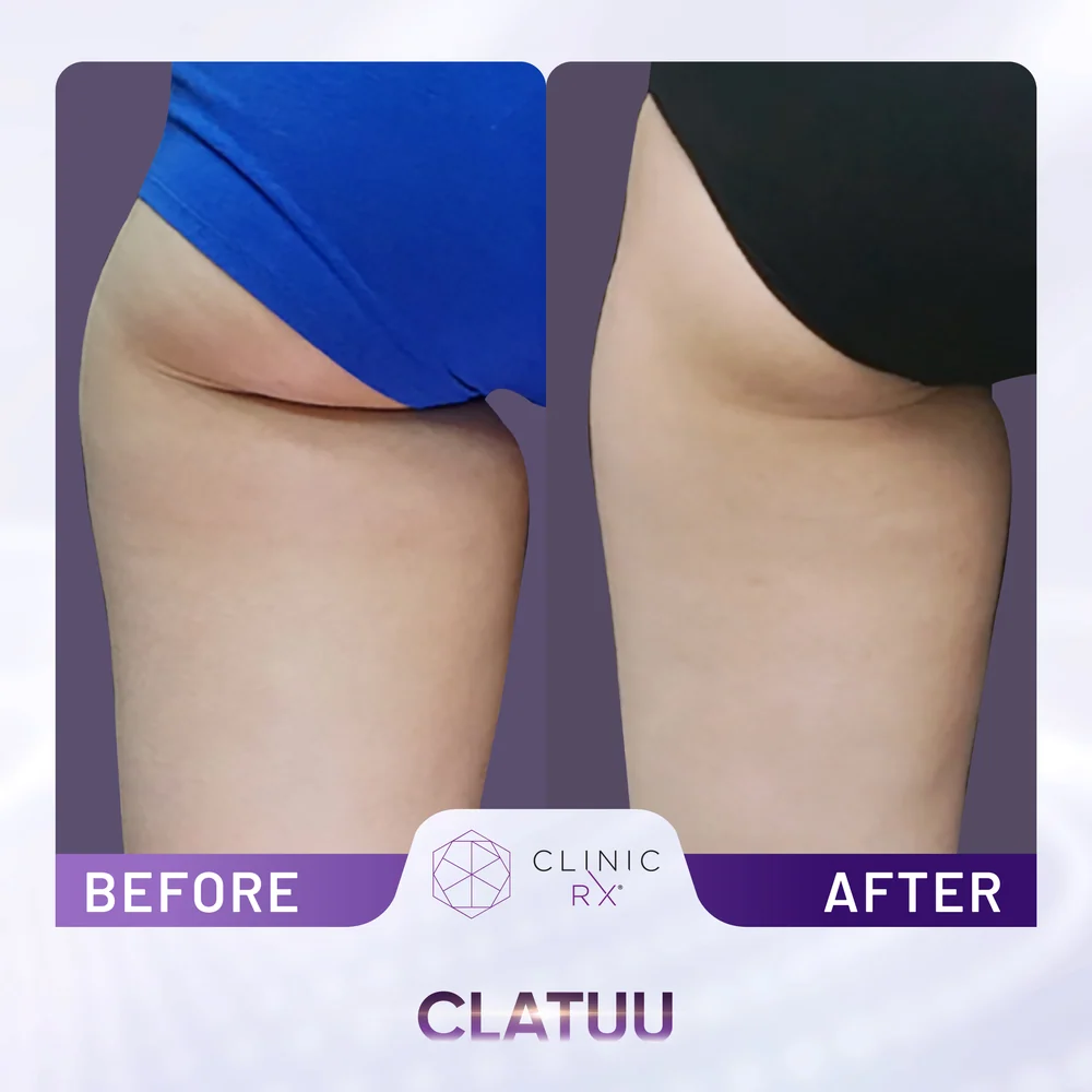 Unwanted Fat result 10
