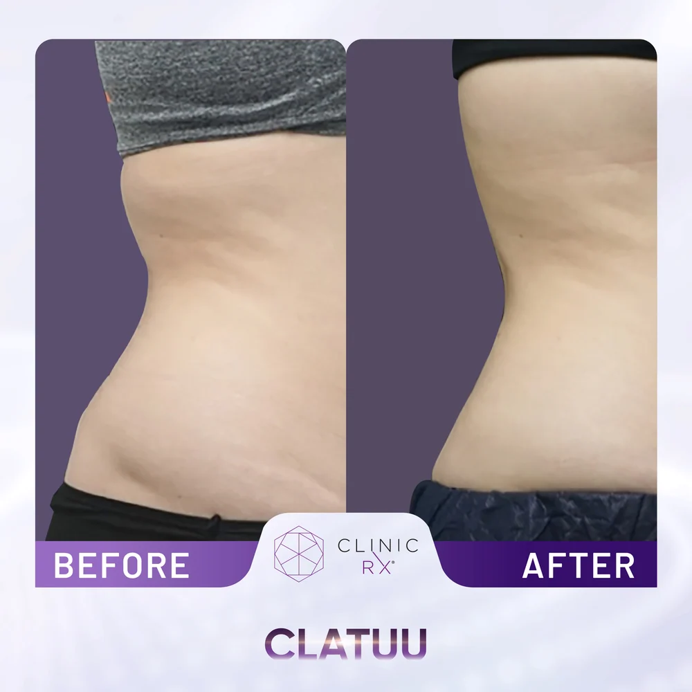 Unwanted Fat result 11