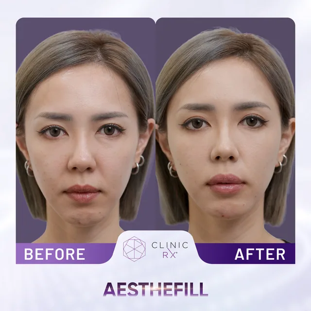 AestheFill actual result 1