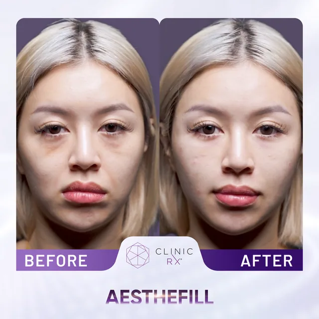 AestheFill actual result 2