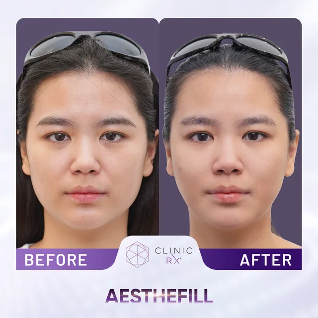 AestheFill actual result 3