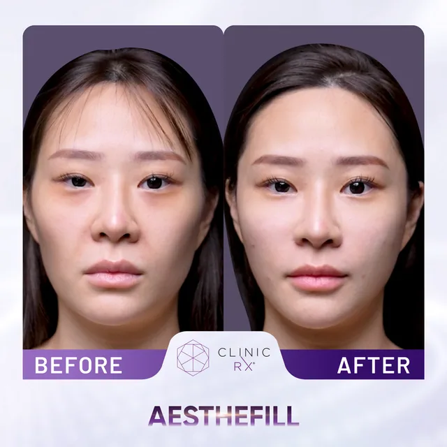 AestheFill actual result 4