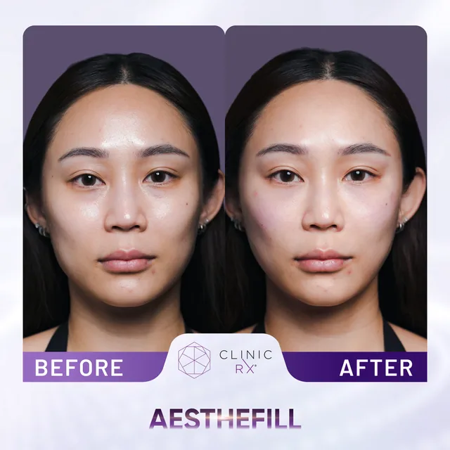 AestheFill actual result 5