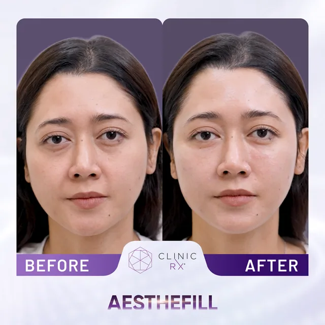 AestheFill actual result 6