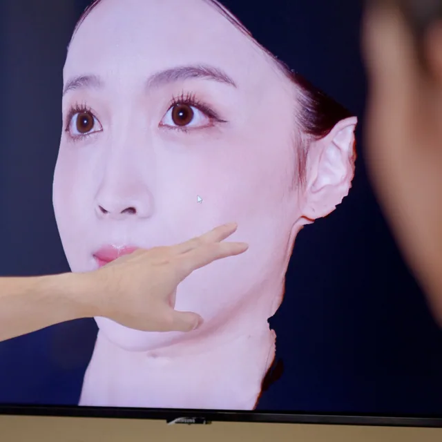 AestheFill treatment step 1