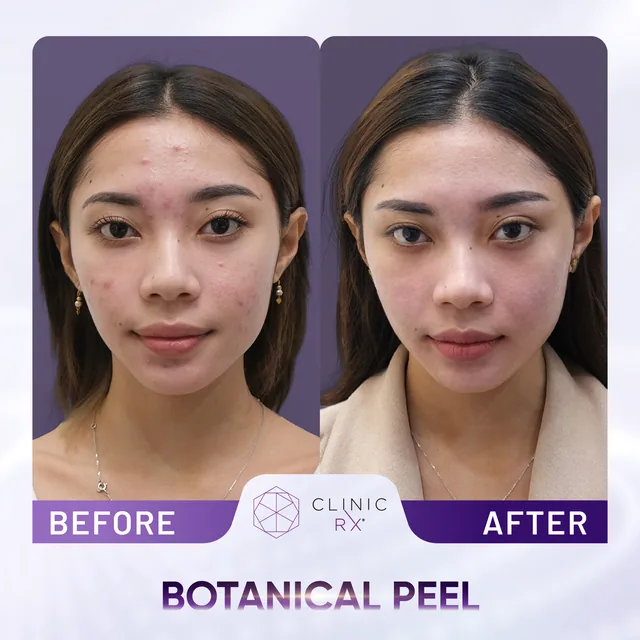 Botanical Peel actual result 1