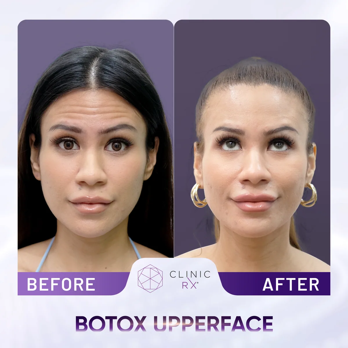 Botulinum Toxin actual result 1