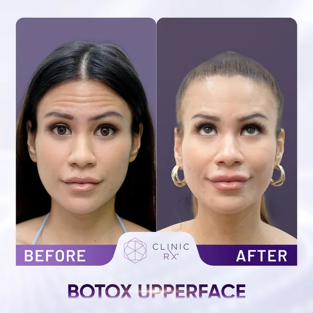 Botulinum Toxin actual result 1