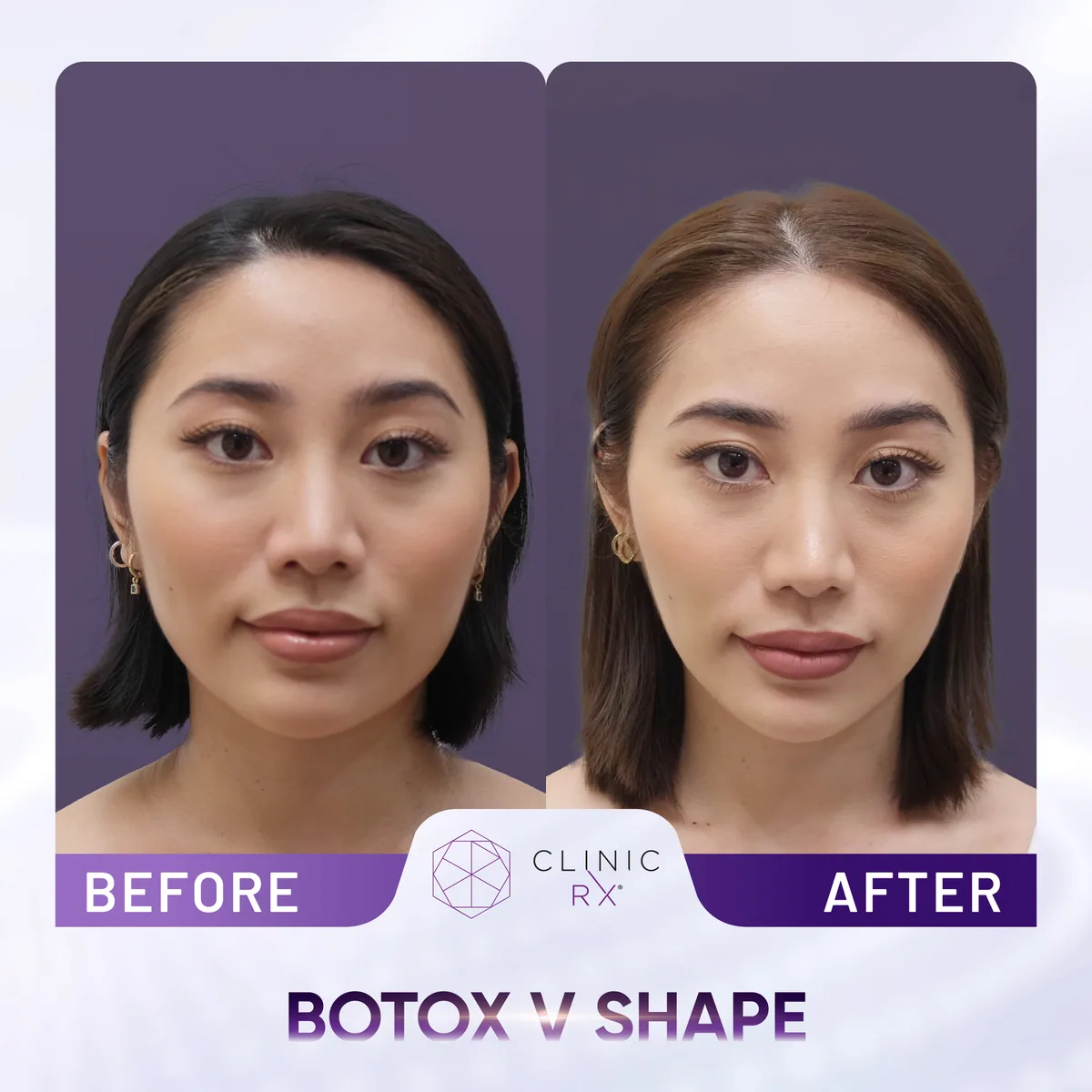 Botulinum Toxin actual result 2