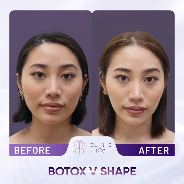 Botulinum Toxin actual result 2