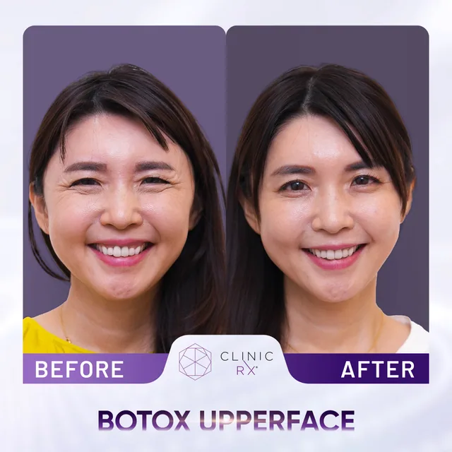 Botulinum Toxin actual result 3