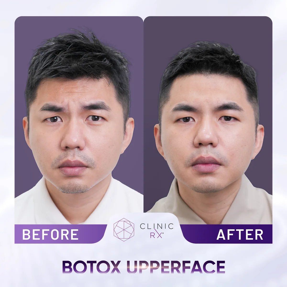 Botulinum Toxin actual result 4