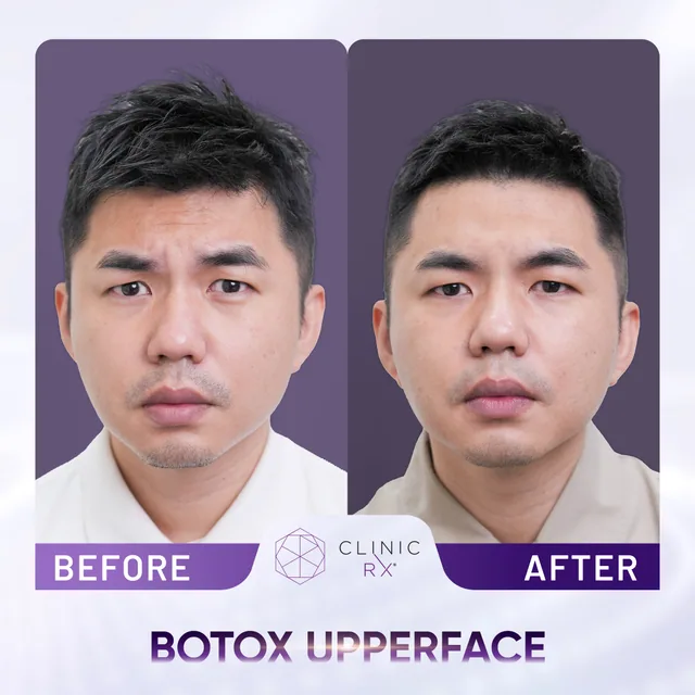 Botulinum Toxin actual result 4