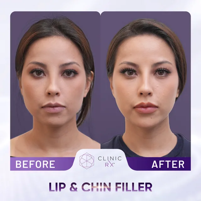 Dermal Filler actual result 1