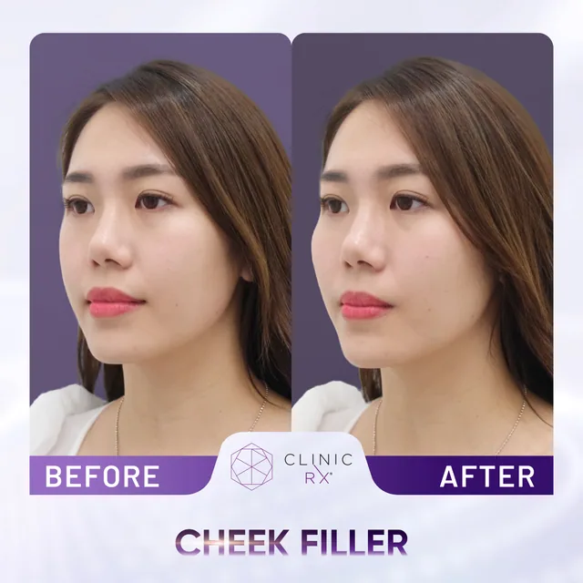 Dermal Filler actual result 2