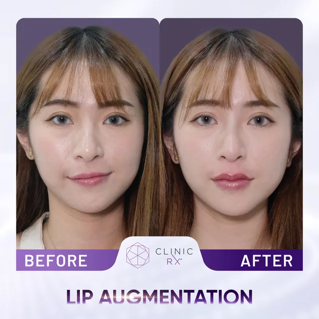 Dermal Filler actual result 3