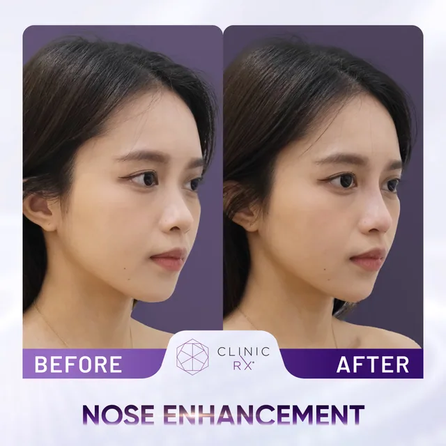 Dermal Filler actual result 4