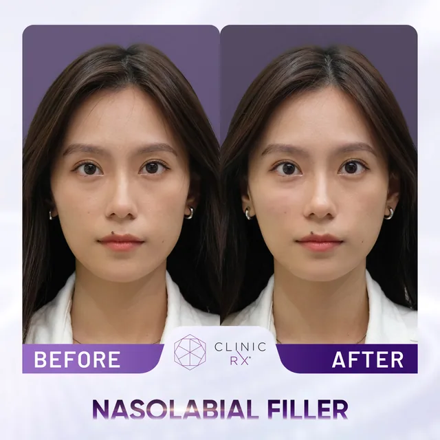 Dermal Filler actual result 5