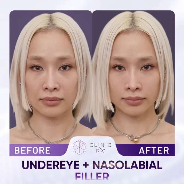 Dermal Filler actual result 6