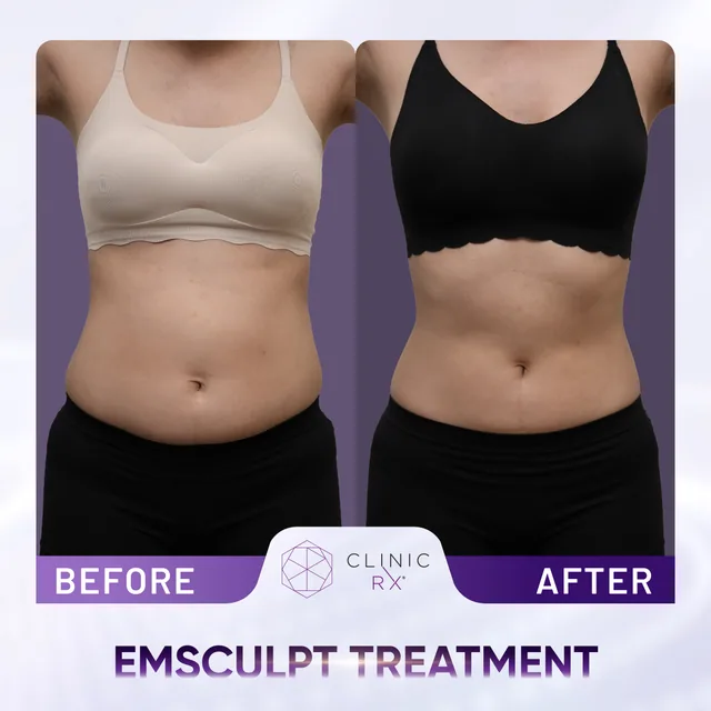 Emsculpt actual result 1