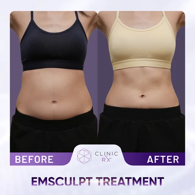 Emsculpt actual result 2