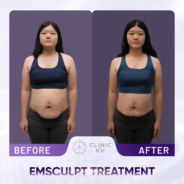Emsculpt actual result 3