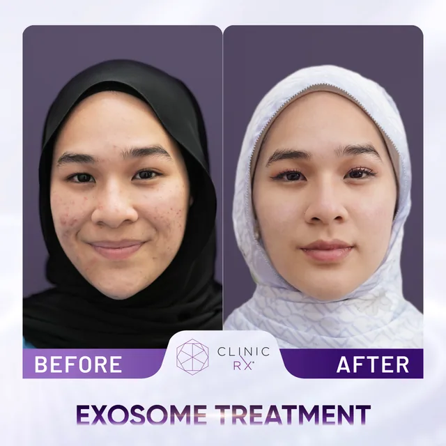 Exosome Therapy actual result 1