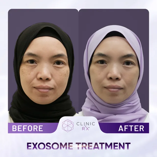 Exosome Therapy actual result 2