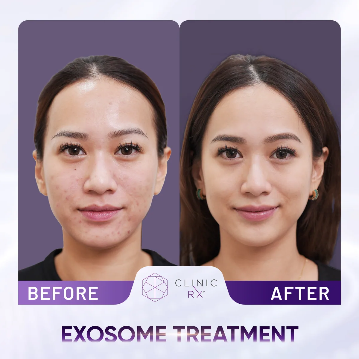 Exosome Therapy actual result 3